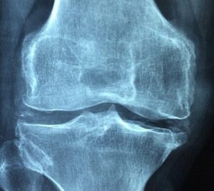 Radio de l'os du genou: la vitamine D3 K2 renforce les os et les articulations.