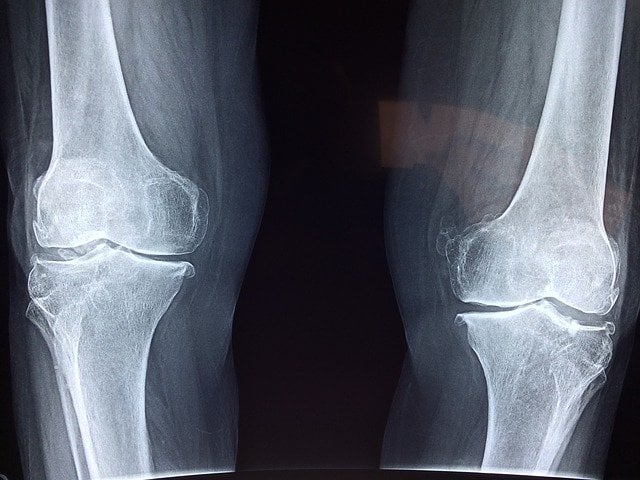 Glucosamine et sulfate de chondroïtine, composants présents dans les cartilages.